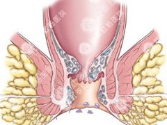 兰州医博肛肠医院：肛门湿疹是不是传染病？