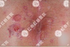 肛门湿疹实例图2