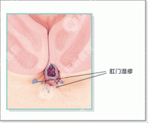 肛门湿疹示意图