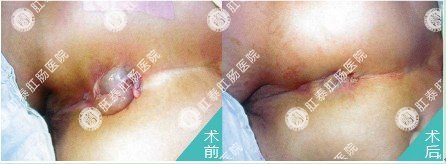 混合痔引发肛门湿疹治疗前后