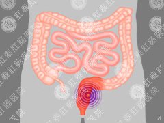 兰州直肠息肉哪家治疗好？
